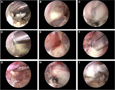 Clinical effects of unilateral biportal endoscopic decompression for lumbar posterior apophyseal ring separation